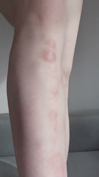 Eu Te Mostro Os Hematomas Nas Minhas Pernas Depois De Sexo