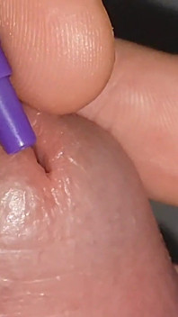 Penis Probing with Application of Fortifying Serum.