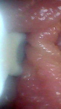 La videocamera endoscopica mostra le parti più sensibili del pene Video educativo