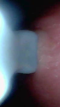 Endoscope Camera Captures Moment of Male Ejaculation 4K