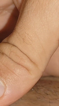 Large Cheese Accumulated in Close up of Glans