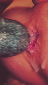 Dilatation Anal