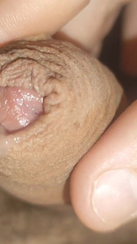 Maximum Dilation of Phimosis Cumming.
