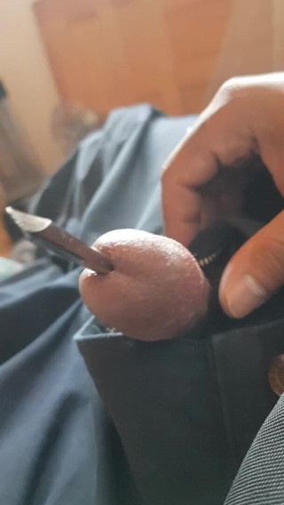 Alejandro Vazquez Flores: Permainan ureteral