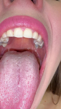 Mouth Secrets: Thick White Coating on My Tongue