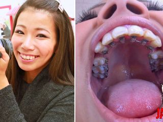 Japan Fetish Fusion: Kieferorthopädischer Zähnefetisch: Izumi Asatos Zahnfantasie