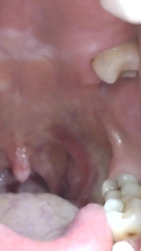 Bên trong miệng lớn của tôi lưỡi răng Uvula