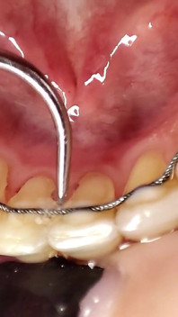 Cleaning Teeth with Toothbrush, Irrigator, Dental Hook