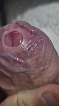 Uncut Tight Phimosis Cock Foreskin Stretched Close up