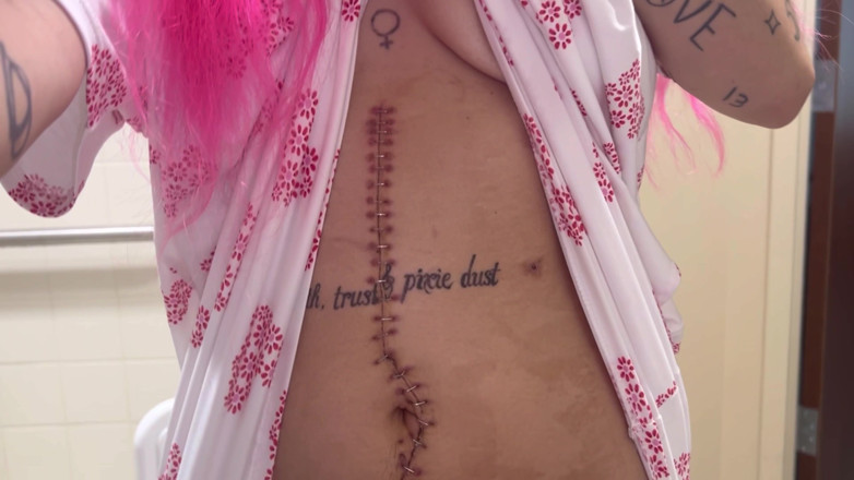 Nali Marie: Scar Fetishes Stitches Staples Hospital Recovery After Surgery Teen Petite...