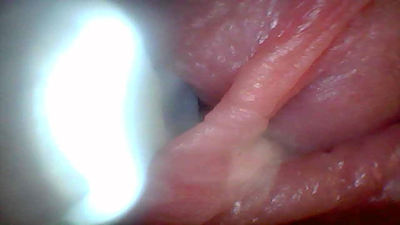 Twittiy: Endoscope Camera Shows the Most Sensitive Parts of the Penis...