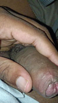 Urine Infection