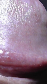 Tayson's glands or pearly papules