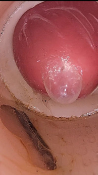 Máy ảnh trong âm hộ sâu ghi lại một lần xuất tinh khổng lồ của tinh trùng vào bao cao su