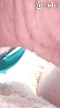 Polissage anal