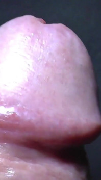 Tayson's glands or pearly papules