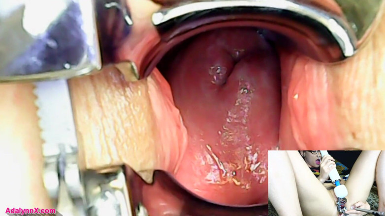 AdalynnX: AdalynnX - endoscoop speculum hitachi vib