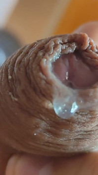 The Glans Appears Crowning Inside the Phimosis.