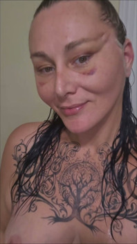 Day 8 Face Lift Recovery....