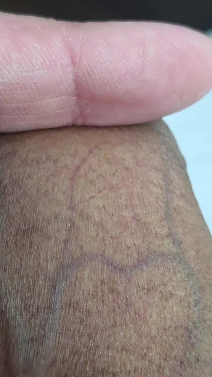 Lkdick8: Apa bintik-bintik ini di penis saya