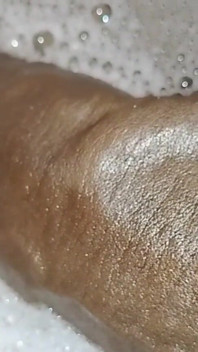 Thick Veins on Cms BBC