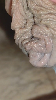 Detaching the Foreskin From the Glans Slowly.