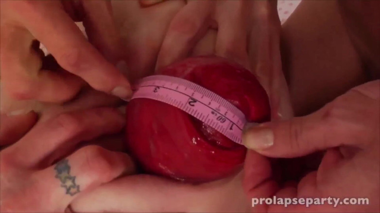 Prolapse party: Sarkma Ölçüsü