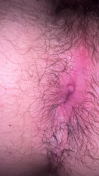 Bruised Asshole