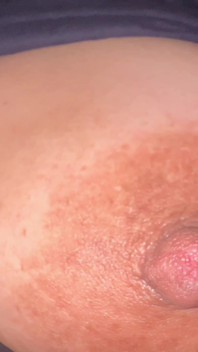 Riesige nippel-montage