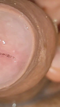 Large Cheese Accumulated in Close up of Glans