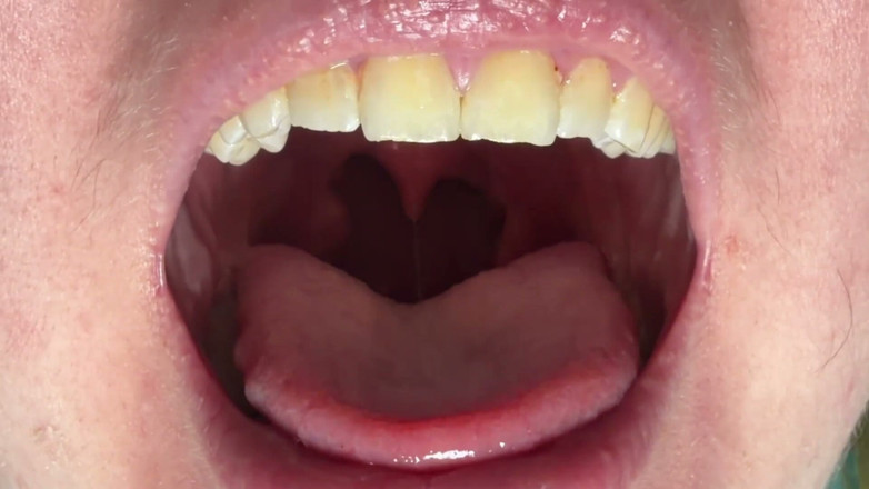 Spunk Kip: Mouth &amp; Tonsils Close-up