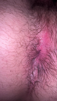 Bruised Asshole