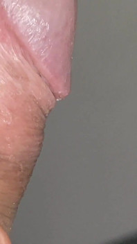 Boy with Large Anal Phimosis Excited!