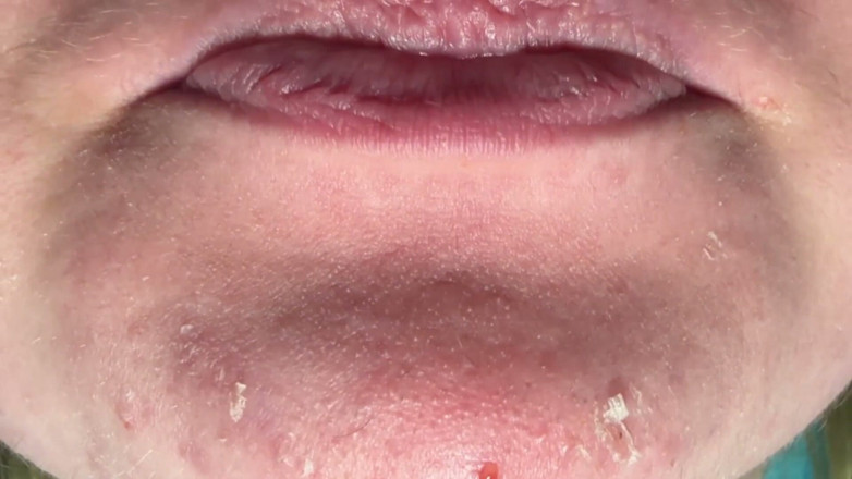 Spunk Kip: Mouth &amp; Tonsils Close-up