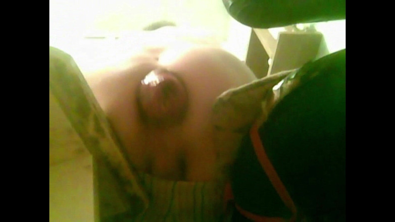 IncredibleGuy: 若い男性が肛門脱を起こして椅子に座っている