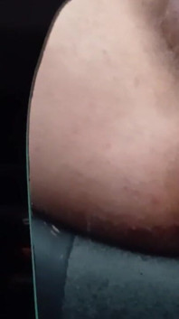 Anus XXX