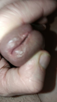 Is My Meatus Open?