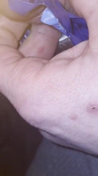 Insertion de méat urinaire à la cire de bougie