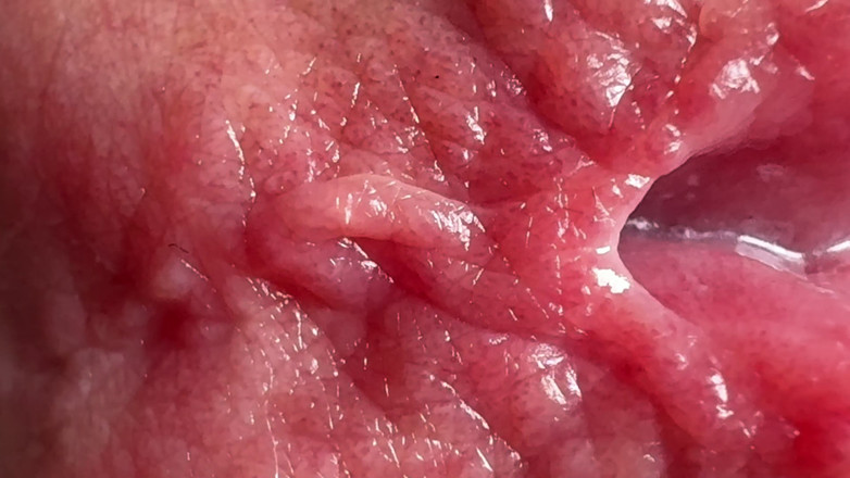 Leonardo-1974: Finger im Penis. Loch in den Penis Penetration.