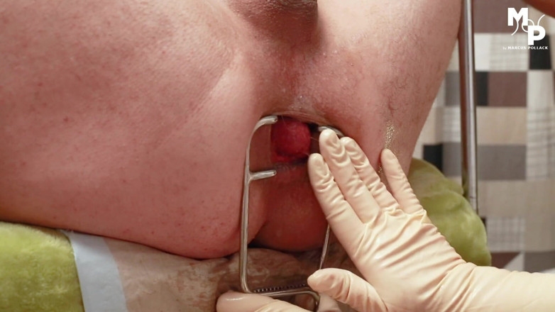 Marcus Pollack: Speculum uitrekkend voor ondergat