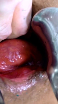 Exl-032: Riesiges Spekulus in Arsch N muschi. Riesiger Prolaps und riesiger Gebärmutterhals. Volle extremelatina szene exl-032