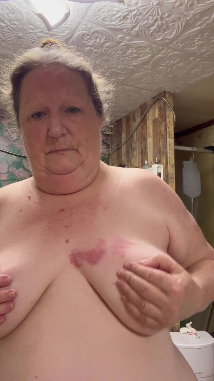PlayfulRose1: Bad Case of Shingles