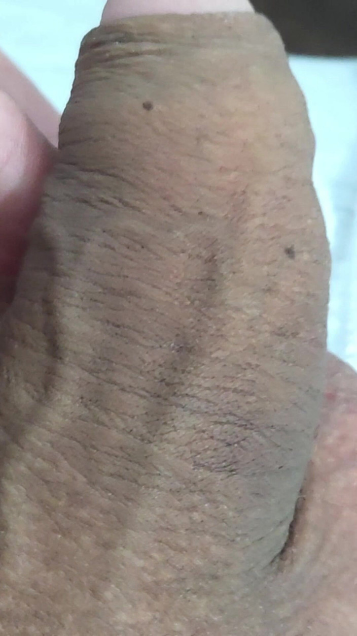 Lkdick8: Apa bintik-bintik ini di penis saya