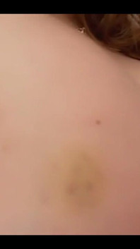 Bruise on Tits Update