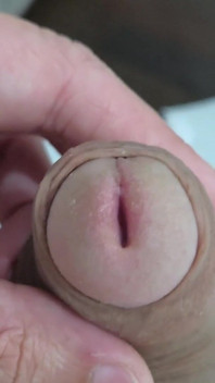 私のペニスのこれらの斑点は何ですか