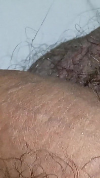 Gresopio nei piedi maschili 16