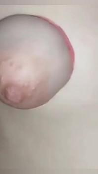 And Breast Tear
