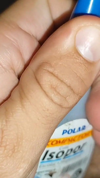 Inserting the Super Glue Through the Boy's Glans.