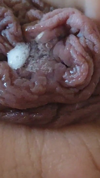Immense Phimosis Being Extracted Cum and Précum.