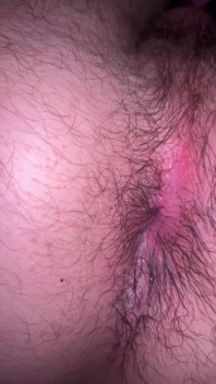 Bruised Asshole